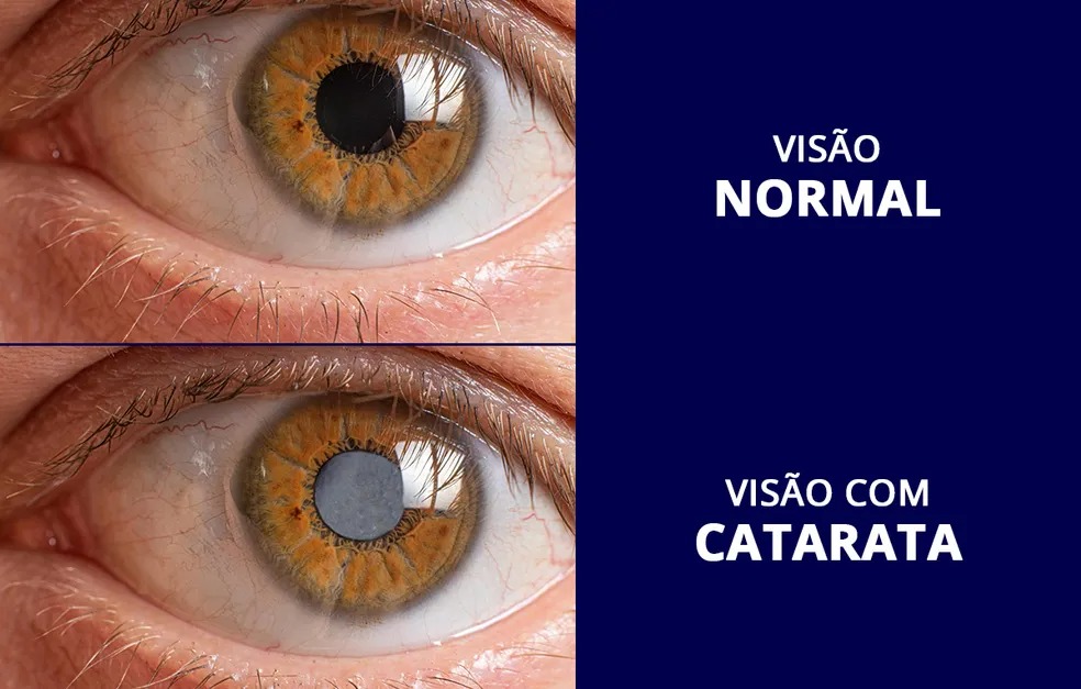 Cirurgia de catarata atinge 98% de precisão com o avanço de lentes inteligentes e protocolos hospitalares de segurança