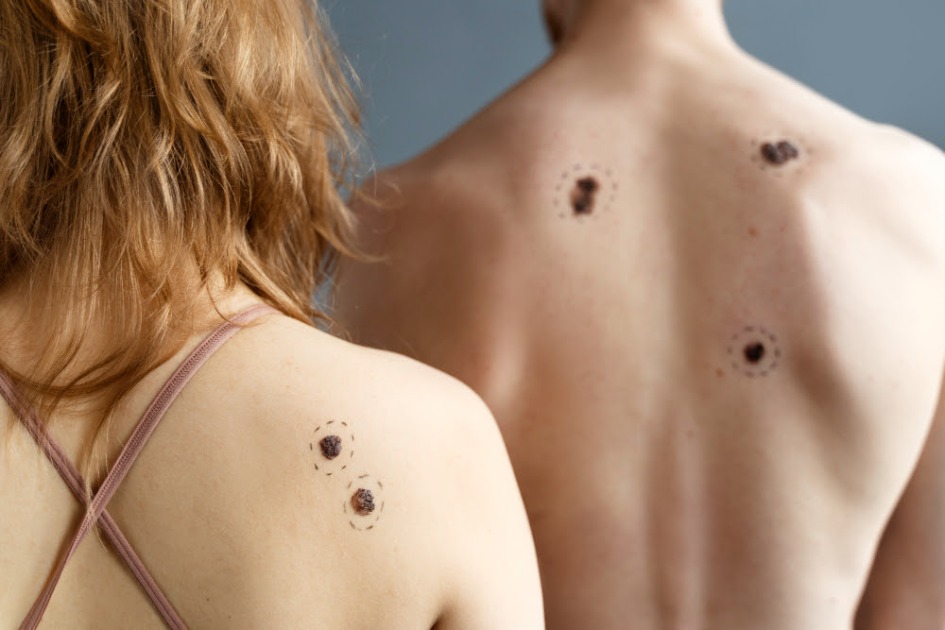 Julho reforça alerta para o melanoma e a importância do diagnóstico precoce